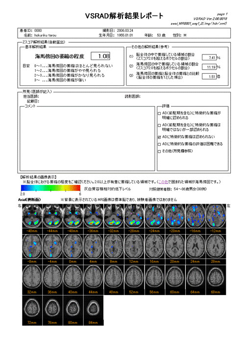 VSARD・萎縮の程度で青から赤へと色分けされます